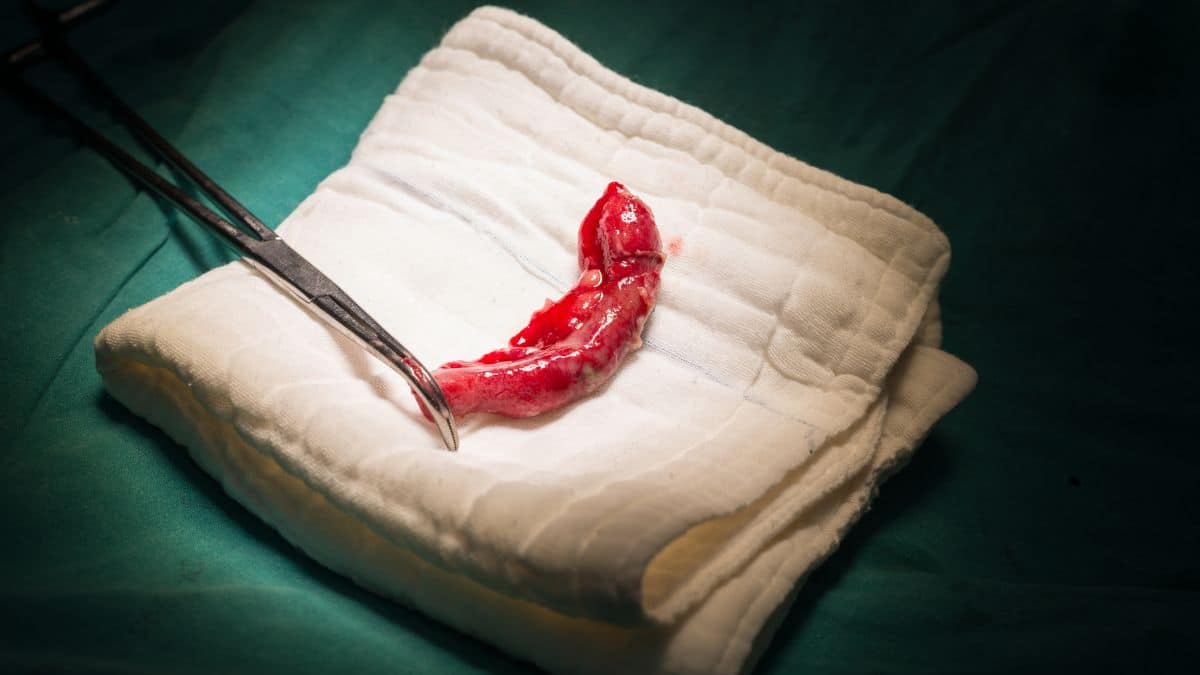 Apendicite: O Guia Completo Sobre Sintomas, Causas e Tratamentos